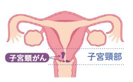 子宮頸がん説明_1681880_marked