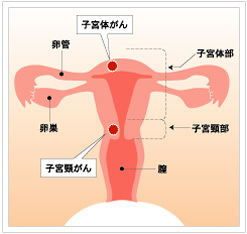 子宮頸がん